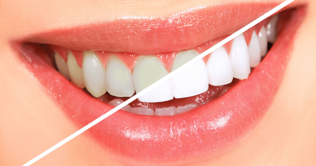 Teeth Whitening - Siebenthaler Dental - featured image